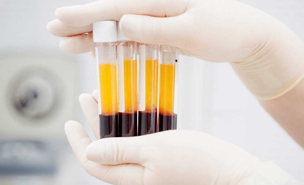 관절염에 대한 PRP 치료를 위한 혈소판 풍부 혈장